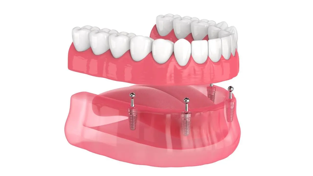 Overdenture